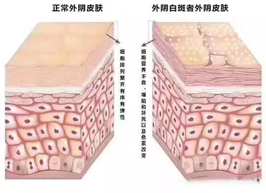 外阴白斑真的能自愈吗?