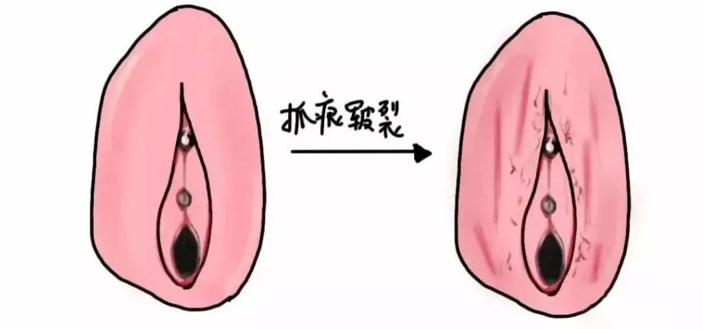 患上外阴白斑是什么颜色
