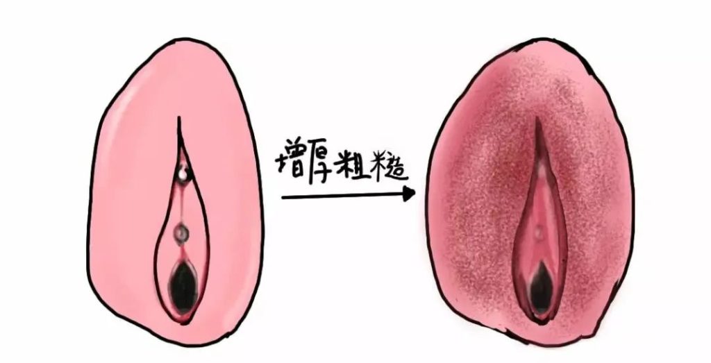 阴白斑的症状有哪些