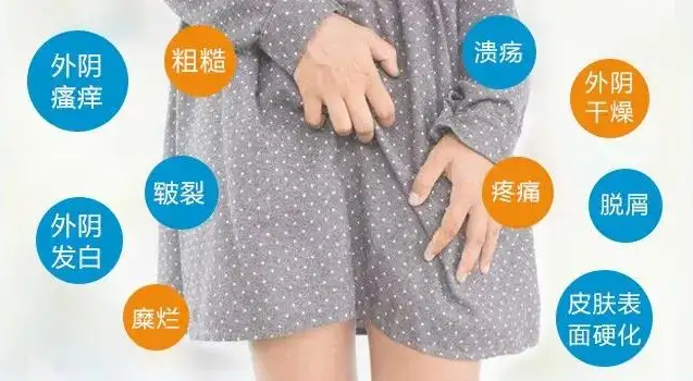 阴白斑的症状有哪些