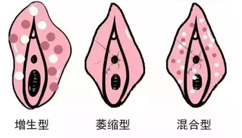 治疗外阴白斑常见的四种心态