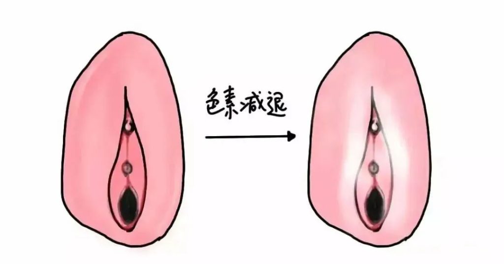 外阴白斑和白癜风有什么区别