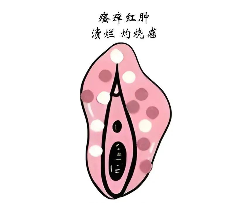 外阴白斑该如何分型分期