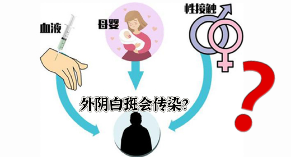 外阴白斑是否具有传染性?