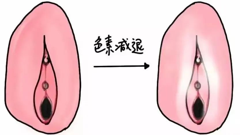 哪些因素会加快外阴白斑的扩散？