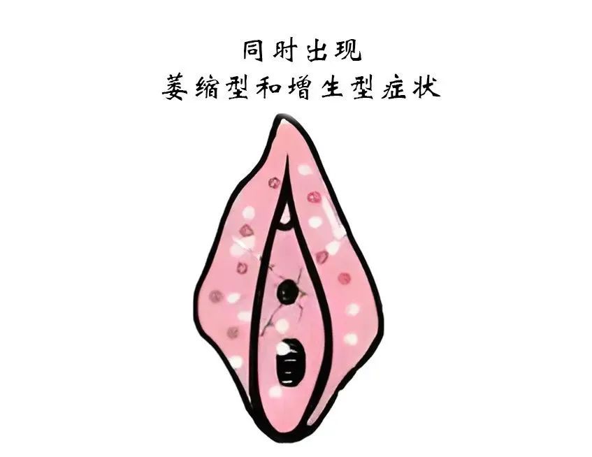 外阴白斑该如何分型分期
