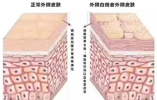 在确诊外阴白斑症状较轻会自己好起来吗?