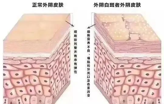 患上外阴白斑后有生命危险吗