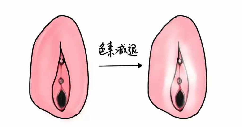 外阴白斑疾病怎么自测？