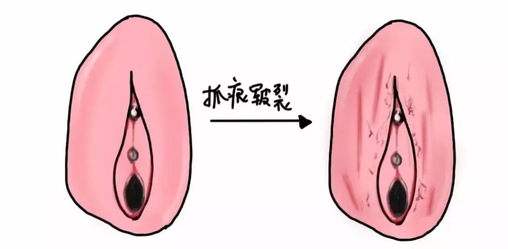 外阴白斑疾病怎么自测？