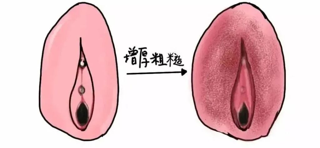 患上外阴白斑是什么颜色