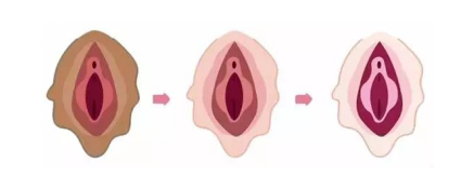 外阴白斑会传染吗?